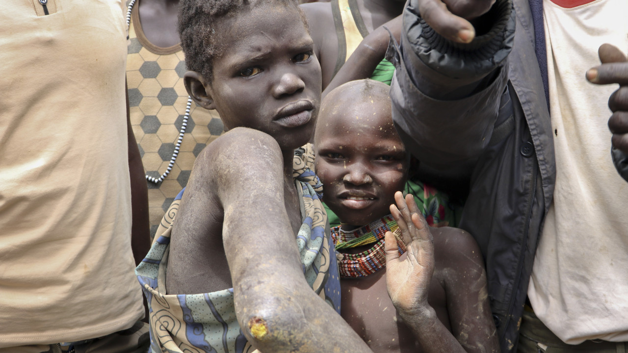 Νότιο Σουδάν: Υποσιτίζονται 1,4 εκατ. παιδιά κάτω των 5 ετών