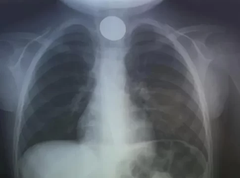 Περιπέτεια για 4χρονο παιδί που κατάπιε κέρμα