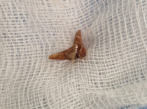 Απίστευτο κι όμως μπορεί να συμβεί: Κρητικιά είχε για μήνες στον πνεύμονά της κόκκαλο από κουνέλι