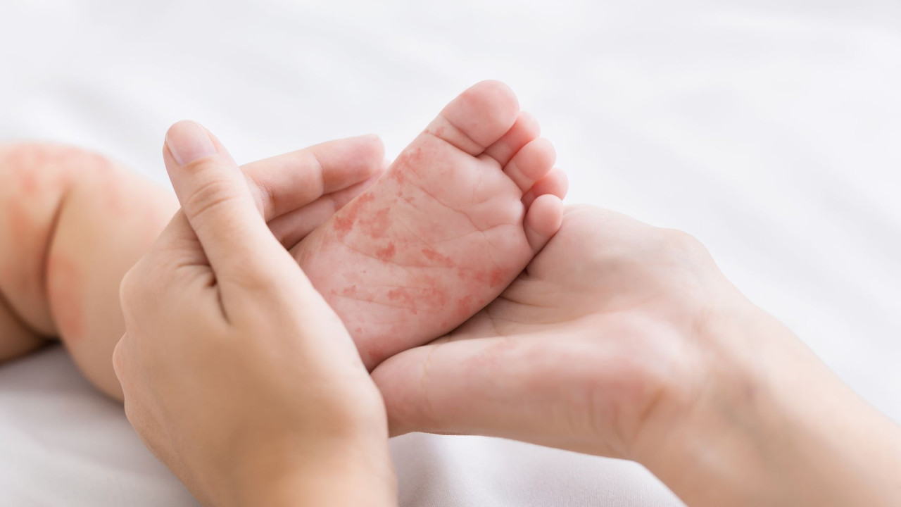 Iλαρά: Η πιο μολυσματική ασθένεια - Η σημασία του εμβολιασμού