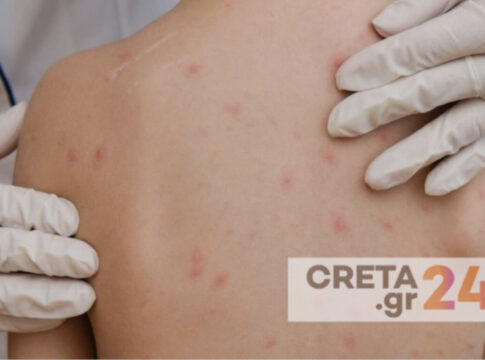 Νέο κρούσμα ιλαράς στην Κρήτη