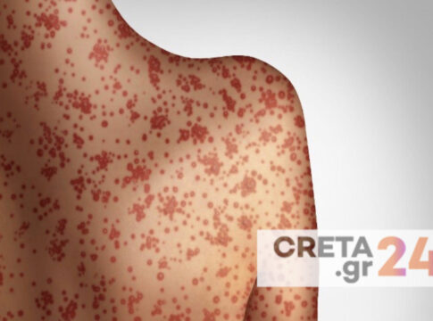 Τρία κρούσματα ιλαράς στην Κρήτη – «Καμπανάκι» και μέτρα από τον ΕΟΔΥ