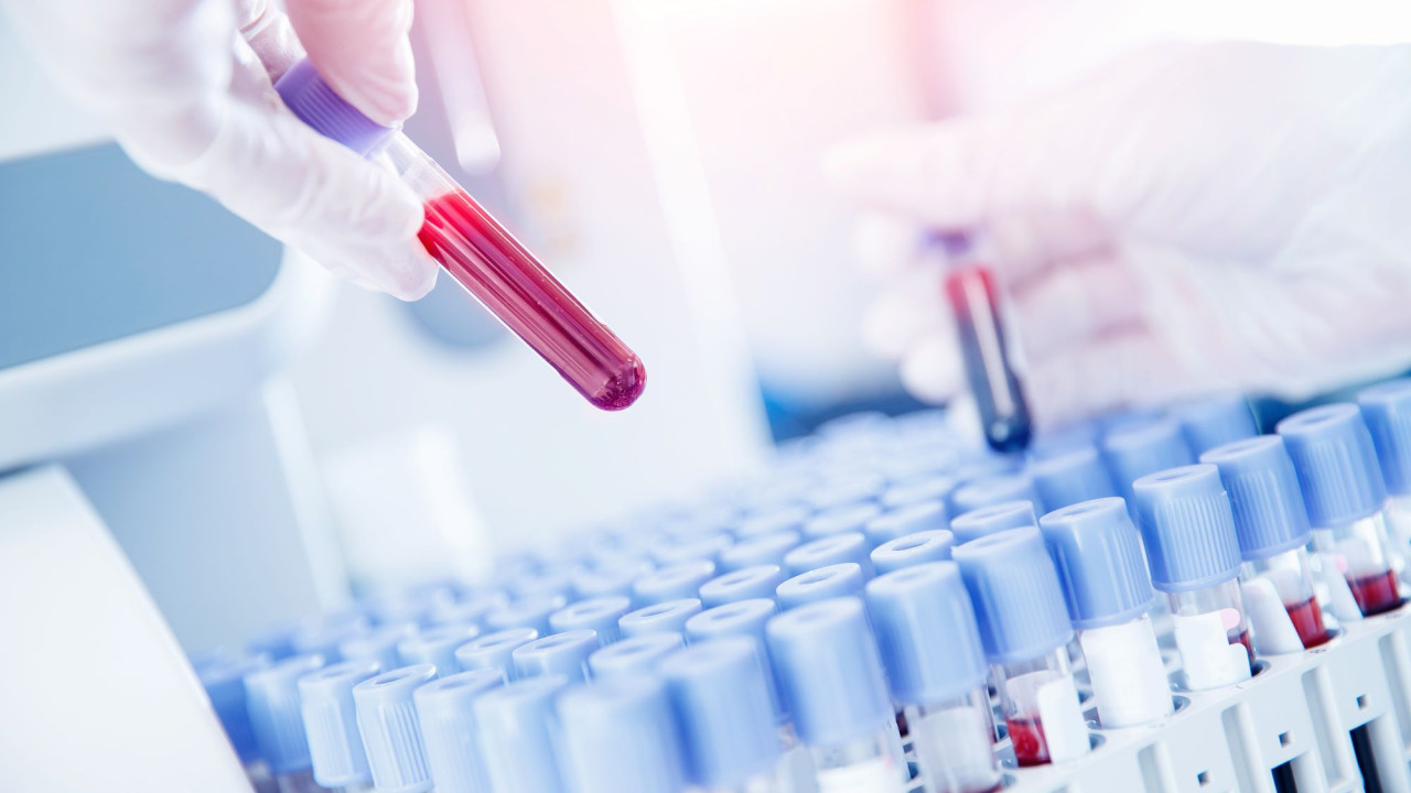 Ελπίδες για την εξάλειψη του AIDS - Γονιδιακή θεραπεία «κόβει» τον HIV από τα κύτταρα