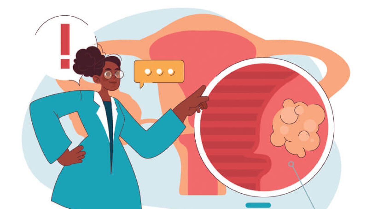 Ινομυώματα: Συμπτώματα, διάγνωση και αντιμετώπιση με εμβολισμό