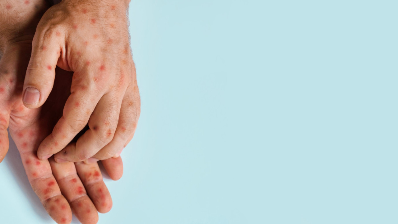 Μpox - ΠΟΥ: Συνεδριάζει η επιτροπή αντιμετώπισης κρίσεων για την ευλογιά των πιθήκων