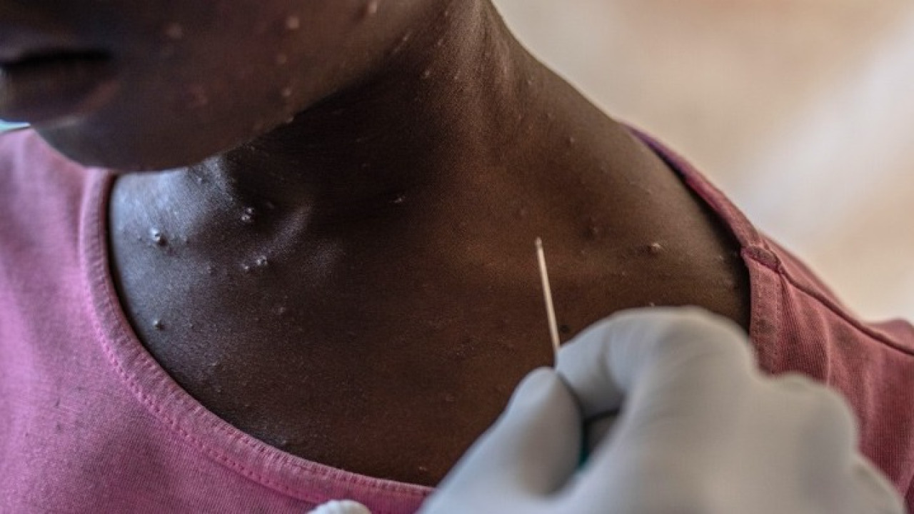 Κονγκό: Έλαβε το πρώτο φορτίο με εμβόλια εναντίον της επιδημίας mpox