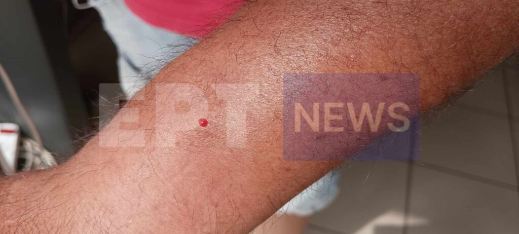 Στο Νοσοκομείο 53χρονος που τον τρύπησε αγκάθι λεοντόψαρου