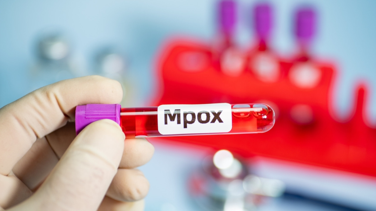 mpox: Τα κρούσματα στην Ευρώπη είναι περισσότερα από όσα είχαν αναφερθεί λέει η Roche