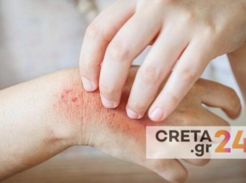 Κρούσματα ψώρας σε σχολείο του Ηρακλείου – Κινητοποίηση των υγειονομικών αρχών