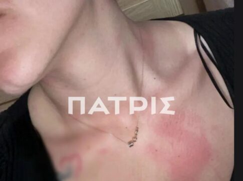 Σοκάρουν τα βίαια χτυπήματα στο κορμί της από τον πρώην σύζυγό της – Τέσσερις καταγγελίες και δύο panic button χρειάστηκαν για να εμφανιστεί η ΕΛΑΣ