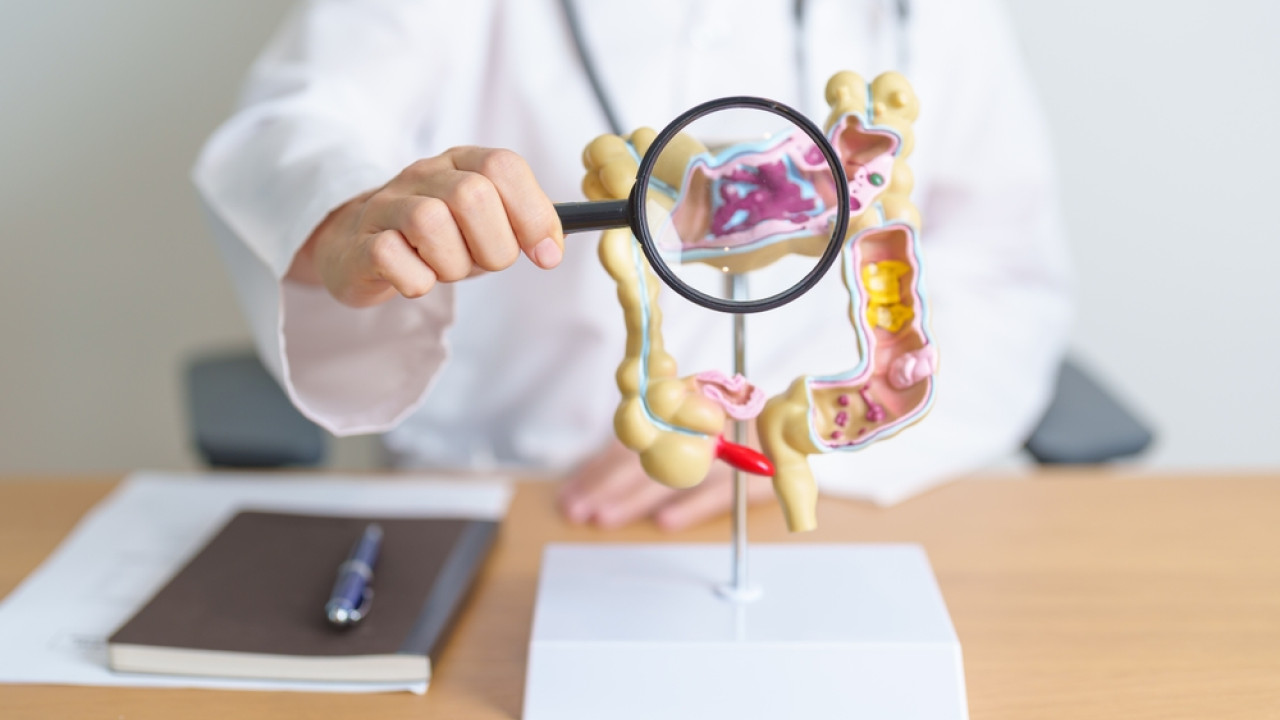 Καρκίνος Εντέρου: Νέα μελέτη εξηγεί πώς εξαπλώνεται ταχύτερα στον οργανισμό