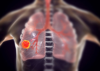 Καρκίνος του πνεύμονα: Καινοτόμος ανοσοθεραπεία, με ελληνική σφραγίδα