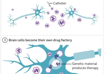 Νόσος του Χάντινγτον: Για πρώτη φορά, επιτυχημένη θεραπεία