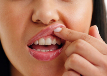 Προσοχή στην «αθώα» ουλίτιδα: Μπορεί να συνδέεται με αυξημένο κίνδυνο σοβαρών καρδιαγγειακών επεισοδίων