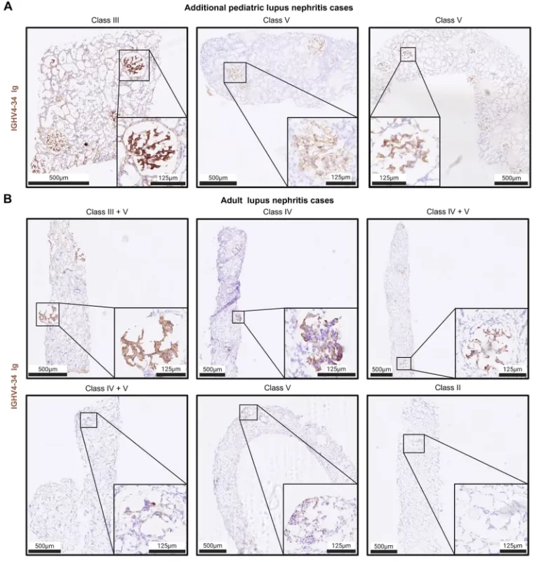 Καινοτόμα θεραπεία των αιματολογικών καρκίνων προτείνει διεθνής έρευνα με ελληνική συμμετοχή