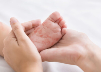 ΕΟΔΥ: Η ιλαρά συνεχίζει να προκαλεί σοβαρές επιπλοκές και θανάτους - Ο εμβολιασμός παραμένει κρίσιμος